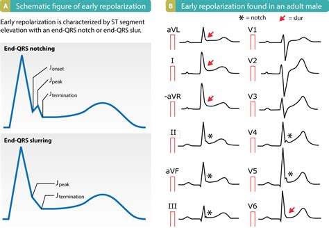 what is high lateral repolarization disturbance